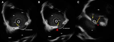 Noblestitch® system for PFO closure: A novel but judicious alternative to traditional devices—A case report